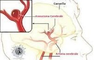 neurochirurgia vascolare Torino