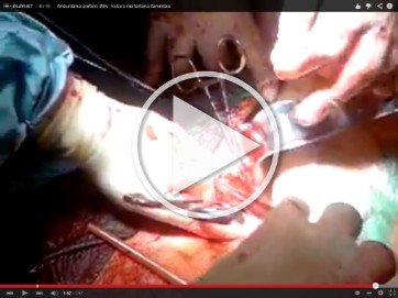Sutura dell'arteria femorale
