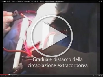 Distacco dalla Circolazione Extra-Corporea 3/3  