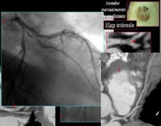 coronaro tc- cardioexpert