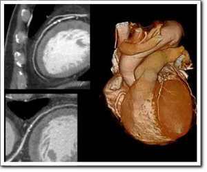 coronarie cardioexpert