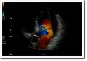 Ecocolor Doppler cardioexpert