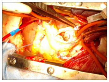 valvola aorta cardioexpert